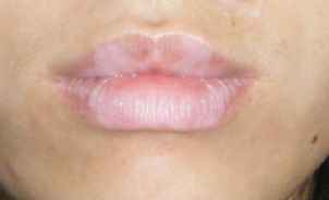 外界哪些因素是唇部白癜风的发病原因
