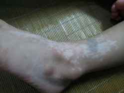 脚上有了一些白斑可以用什么方法有效治疗